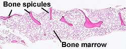 all my patients get bone spicules