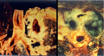 Mediastinal tumor