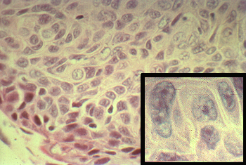 Malignant squamous cells