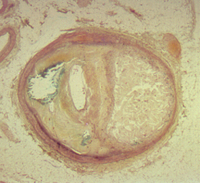 Athersclerosis