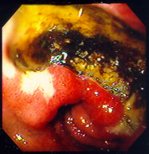 Gastric ulcer