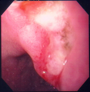 Gastric ulcer