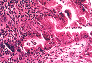 Numerous acute inflammatory cells