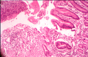 Margin of gastric ulcer