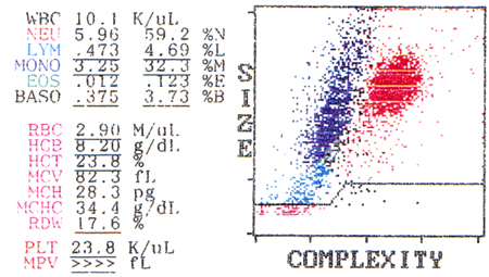 Chronic myelogenous leukemia