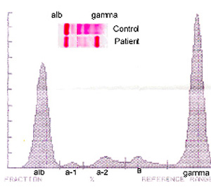 Gamma spike