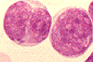 Lymphoblasts