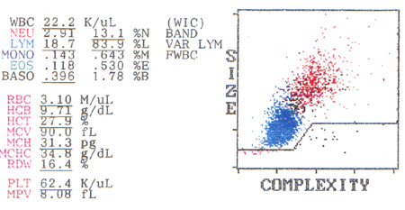 Acute lymphoblastic leukemia