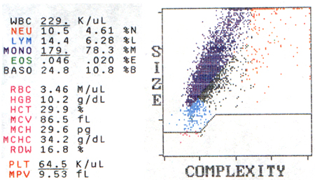 Acute myelogenous leukemia