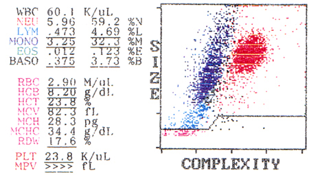 Chronic myelogenous leukemia