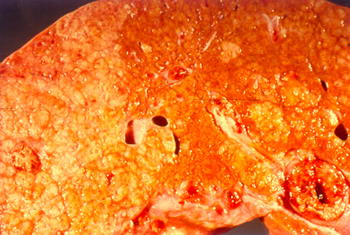 Hepatocelullar carcinoma