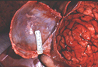 Cerebral edema and bleeding