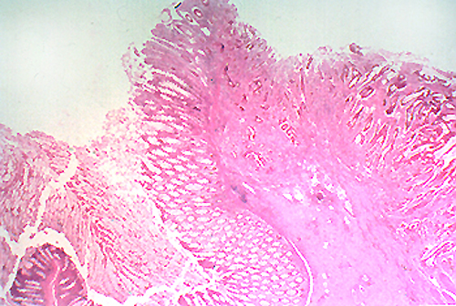 Area of malignancy