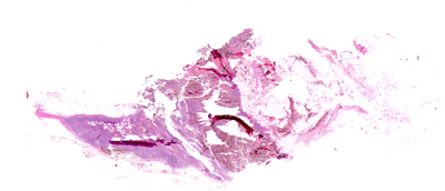 Lymph node biopsy