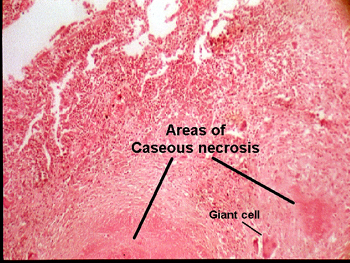 caseous necrosis histology