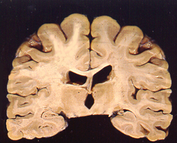 White matter with MS